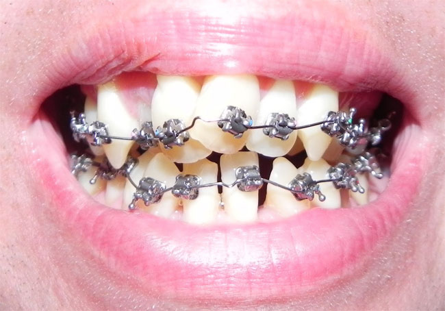 DIY Braces