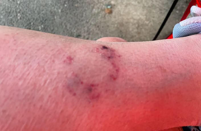 Bruise left by a simply EKG lead sticker. Photo taken by and the property of FourWalls. Bruise left by a simply EKG lead sticker. Photo taken by and the property of FourWalls.