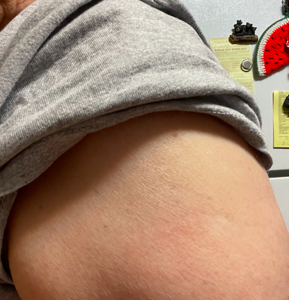My faded smallpox vaccine mark. Photo (poorly) taken by and the property of FourWalls. My faded smallpox vaccine mark. Photo (poorly) taken by and the property of FourWalls.
