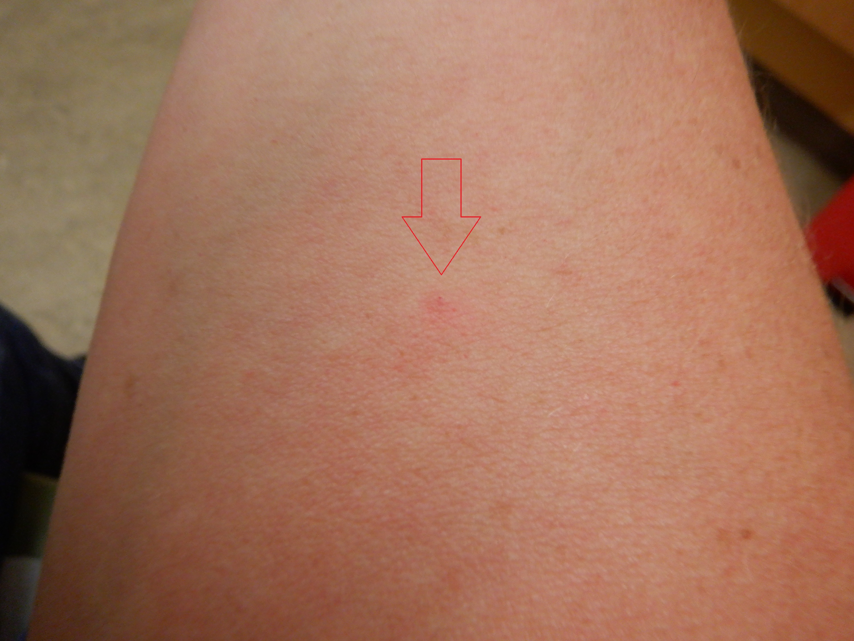 Photo I took of the arm with the TB shot Photo I took of the arm with the TB shot