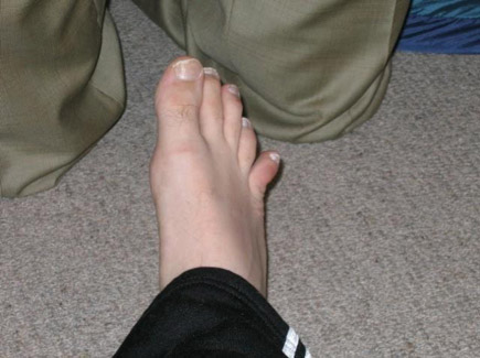 Google - broken toe