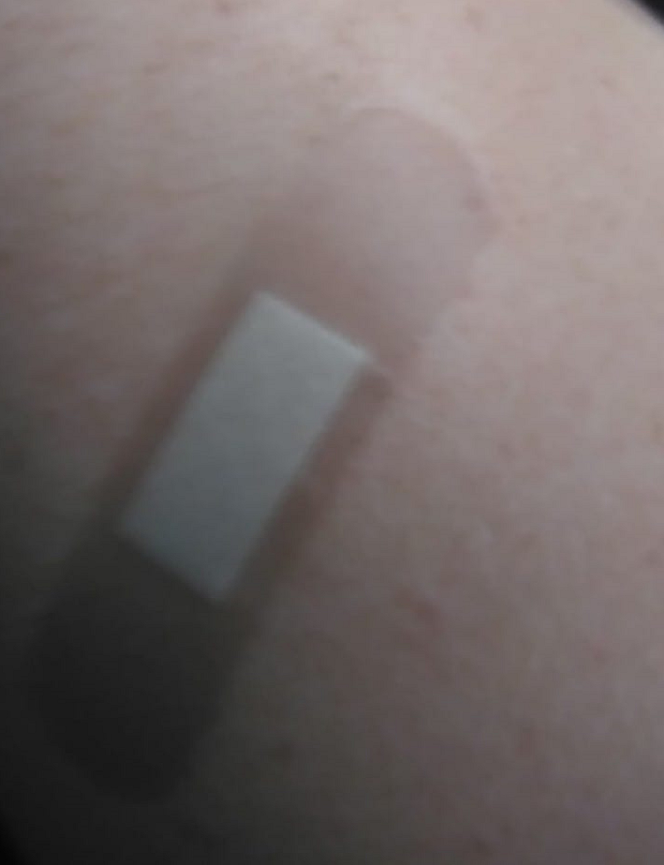 Photo I tried to take of my arm. 