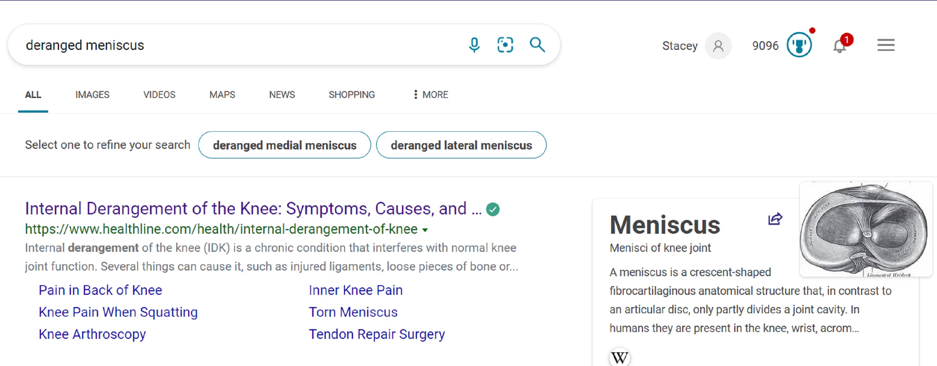 Screencap of Deranged Meniscus search Screencap of Deranged Meniscus search