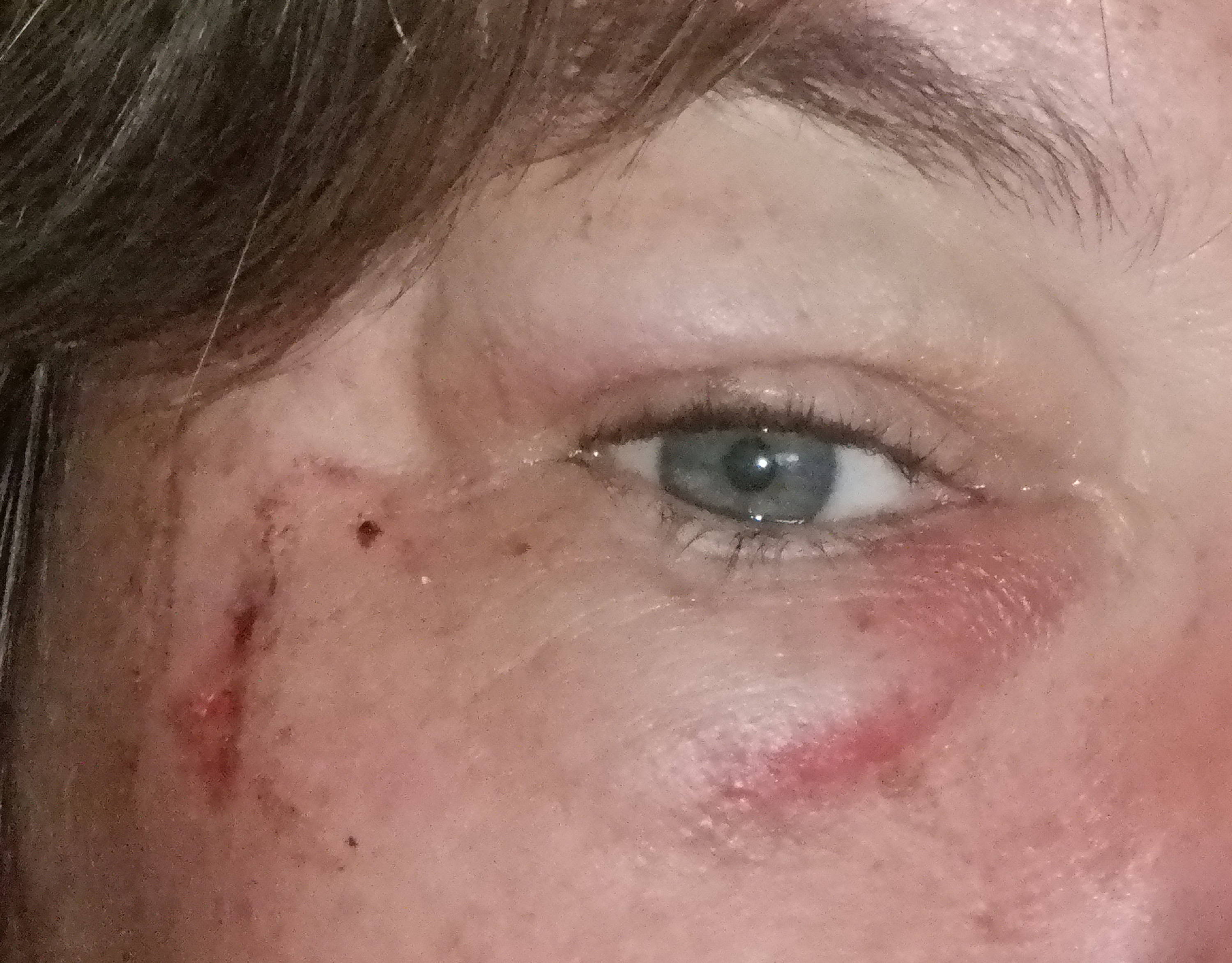 The "not black eye" I'm developing The "not black eye" I'm developing