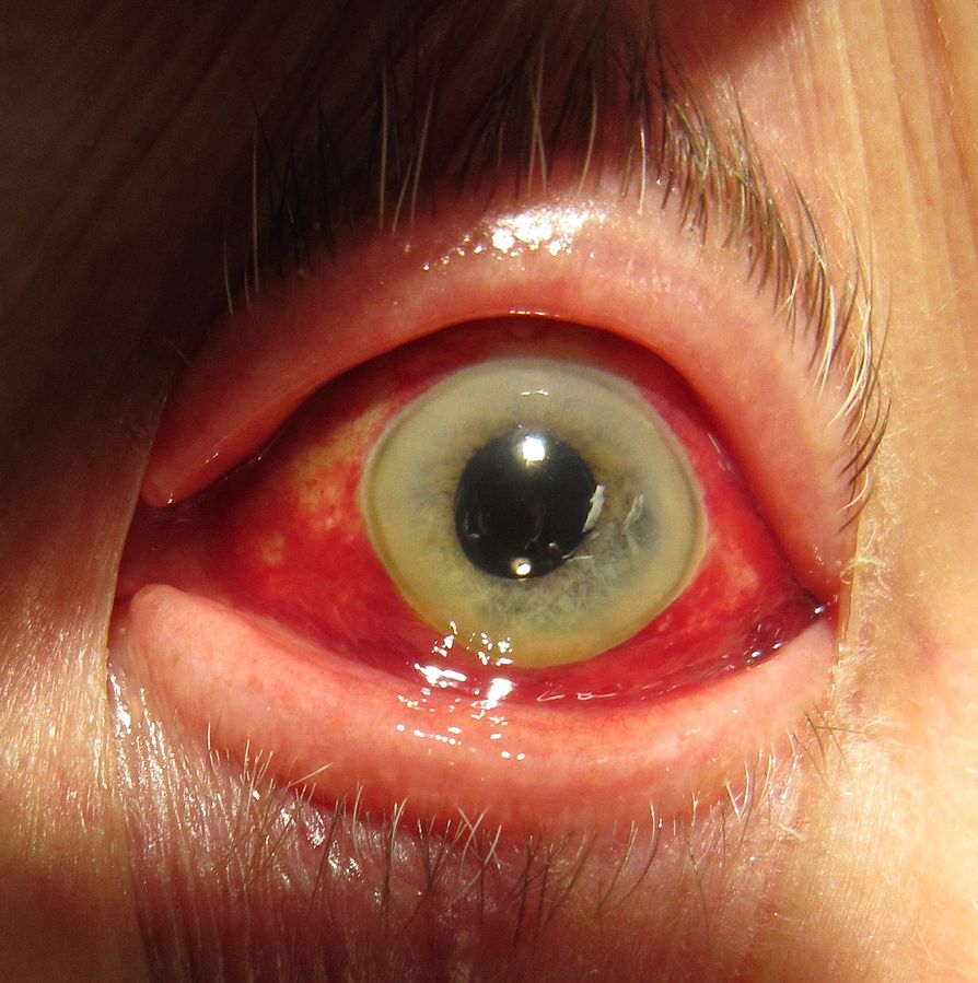 https://commons.wikimedia.org/wiki/File:Human_eye_showing_subconjunctival_hemorrhage.jpg https://commons.wikimedia.org/wiki/File:Human_eye_showing_subconjunctival_hemorrhage.jpg