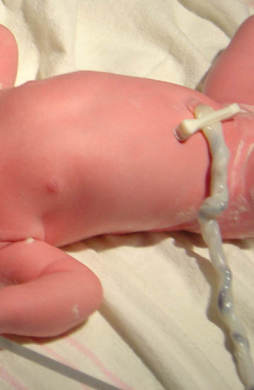 https://commons.wikimedia.org/wiki/File:Umbilicalcord.jpg https://commons.wikimedia.org/wiki/File:Umbilicalcord.jpg