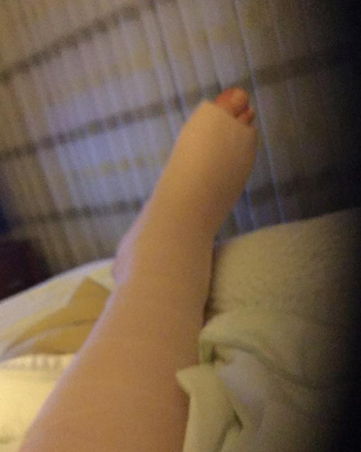 Selfie of my broken ankle.