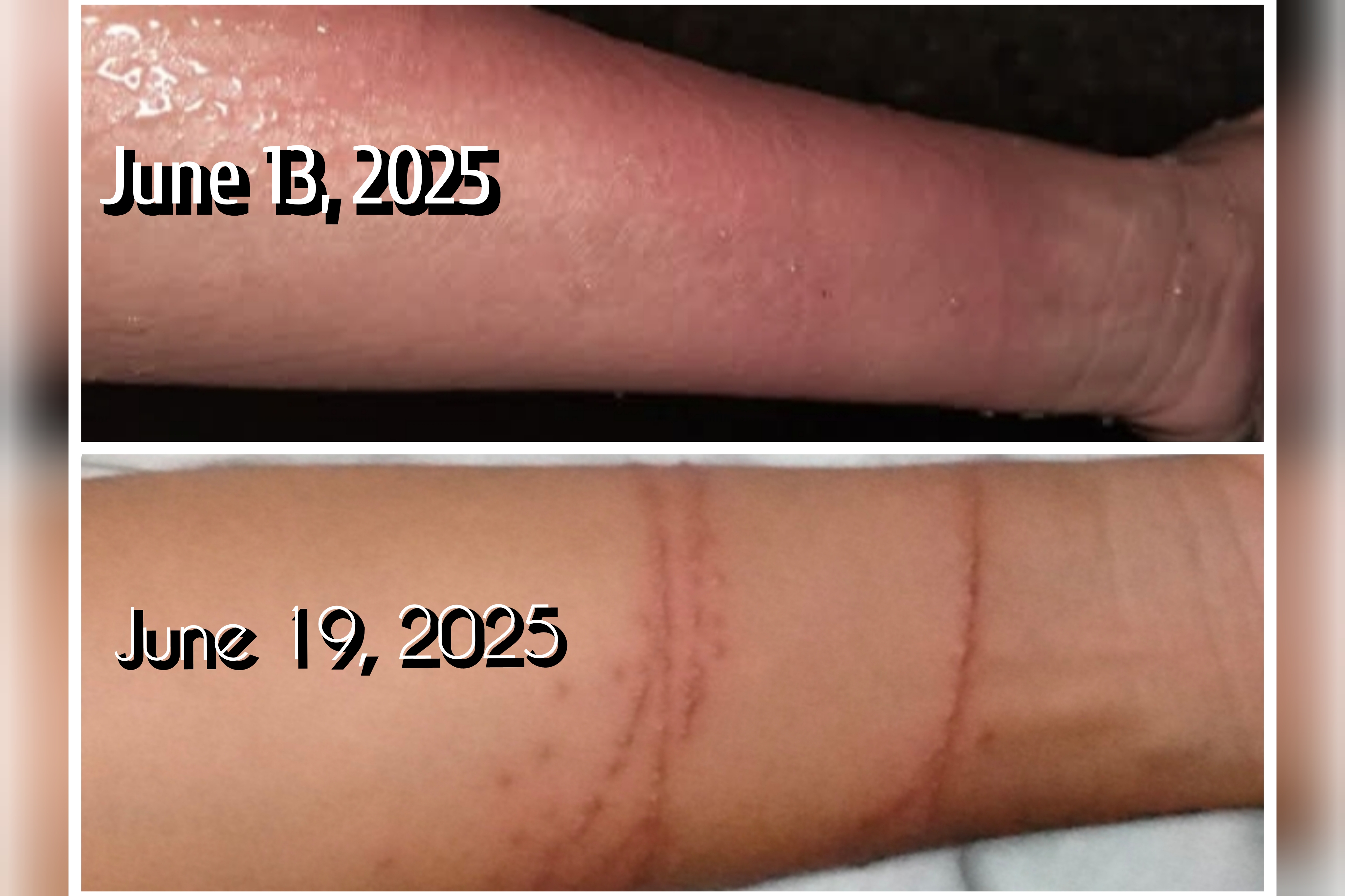 Seawasp Sting on my left arm 