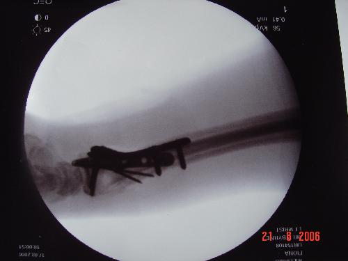 My Broken Wrist  - I broke my wrist a few months ago - here's how I did it! I went down the garden to feed my 2 sheep& noticed one had become tangled round a rock. As I was freeing him he suddenly got spooked& I got caught up in his chain. He dragged me halfway down the garden (he's a big lad), and I ended up amongst a big pile of rocks and in extreme pain. I looked at my wrist and well, can't say I've ever seen anything like it in my life! I now have lots of lovely metalwork& pins holding it all together and it'll have to stay in for life. My hand is still numb, because of nerve damage after the operation - but I've been told it will take 6months to 2 years to get better.