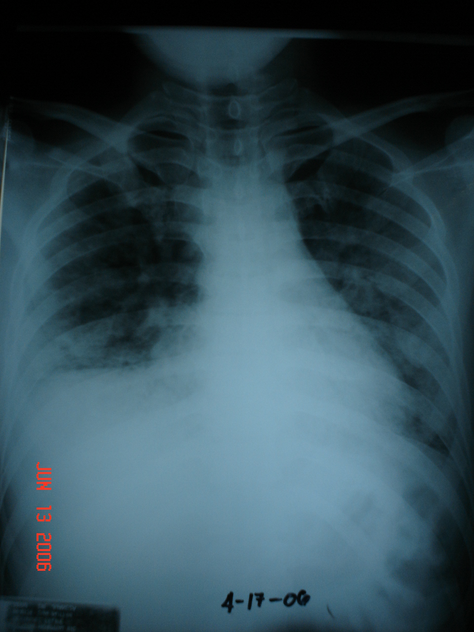x-ray