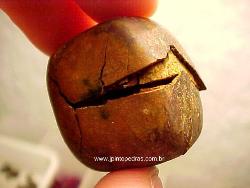 gall stone - gall stone