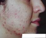 acne1 - example acne foto