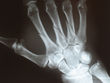 fracture - fracture fracture - fracture