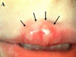 coldsore - this is the cold sore the man had on his lip i took a picture of it with my camera phone