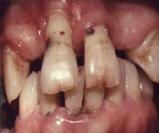 Gingivitis - Kiss to DARE!