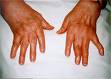 rheumatoid arthritis - rheumatoid arthritis My hands look something like this