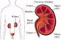 esrd kidney - patient having a kidney