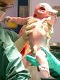  caesarean -  caesarean