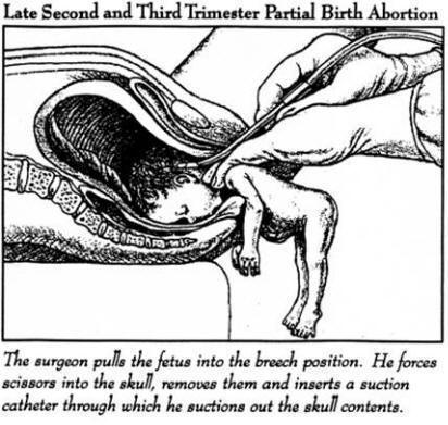 abortion - abortion