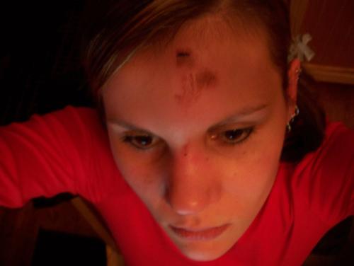 Ouch! - Terrible picture of my forhead from a fall last friday!  As I was running in to the house, my little puppy ran in between my feet causing me to stumble and fall.  Yesterday my face was so swollen, my eyes were almost shut!  Getting better though.