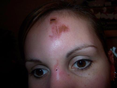 Close up of OUCH! - Here is a picture closer up of my fall from my stumbling over my pup.  Slowly, but surely it's healing up.
