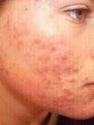 acne - Teens, babies, and adults get it but why?