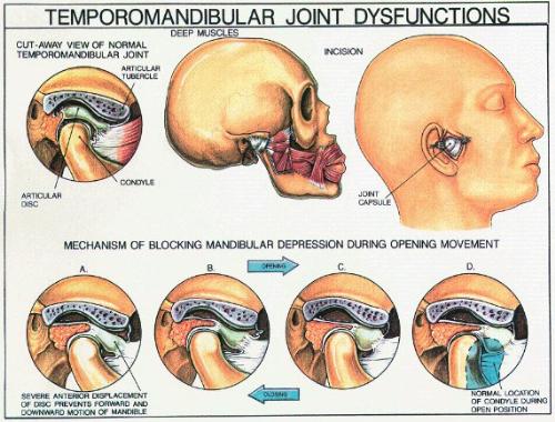 TMJ - Here's a little thing about TMJ.