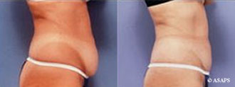 Plastic Surgeries - A picture that shows the before and after images of a tummy tuck procedure.