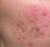 pimples scar - pimples pimples scar - pimples