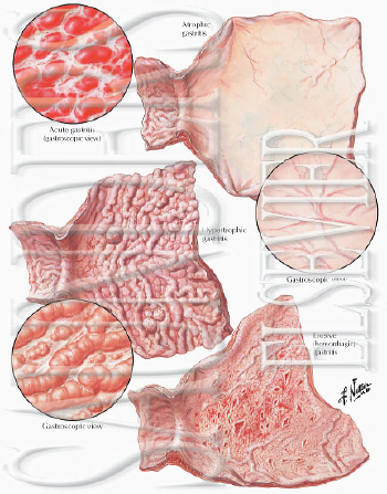 Gastritis - Gastritis is an inflammation of the lining of the stomach. The inflammatory lesions may be either acute or chronic.