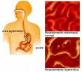 Gastritis Hipertrofica - Gastritis isn't one disease but a group of conditions, all of which are characterized by inflammation of the lining of your stomach. Commonly, the inflammation results from infection with the same bacterium that causes most stomach ulcers. Yet other factors — including traumatic injury and regular use of certain pain relievers — also can contribute to gastritis.  In spite of the many conditions associated with gastritis, the signs and symptoms of the disease are very similar: A burning pain in your upper abdomen and occasionally, bloating, belching, nausea or vomiting.  In some cases, gastritis can lead to ulcers and an increased risk of stomach cancer. For most people, however, gastritis isn't serious and improves quickly with treatment.  Signs and symptoms  The signs and symptoms of gastritis, which are often relatively mild and short-lived, include:      * A gnawing or burning ache or pain (indigestion) in your upper abdomen that may become either worse or better when you eat     * Nausea     * Vomiting     * Loss of appetite     * Belching or bloating     * A feeling of fullness in your upper abdomen after eating     * Weight loss  Gastritis that occurs suddenly (acute gastritis) usually results in the classic combination of nausea and burning pain or discomfort in your upper abdomen, whereas chronic gastritis, which develops gradually, is more likely to cause a dull pain and a feeling of fullness or loss of appetite after a few bites of food. For many people, though, chronic gastritis causes no problems at all.  Occasionally, gastritis may cause stomach bleeding, but it's rarely severe unless there's also ulceration of your stomach lining. Bleeding in your stomach can cause you to vomit blood or pass black, tarry stools and may require immediate medical care.  Because gastritis is one of many common digestive problems with similar signs and symptoms, it's easy to confuse with other conditions, including:      * Gastroenteritis. Also called stomach flu, gastroenteritis usually results from a viral infection of your intestines. Signs and symptoms include diarrhea, abdominal cramps, and nausea or vomiting, as well as indigestion. Symptoms of gastroenteritis often resolve within a day or two, whereas the discomfort of gastritis may be ongoing.     * Heartburn. This painful, burning sensation behind your breastbone usually occurs after a meal. It develops when stomach acid backs up into your esophagus, the tube that connects your throat to your stomach. Heartburn can also lead to a sour taste and the sensation of partially digested food re-entering your mouth.     * Stomach ulcers. If a gnawing or burning pain in your stomach is persistent and severe, you may have an ulcer. Stomach (peptic) ulcers are open sores that develop on the inside lining of the stomach. The most prominent symptom is pain, which is frequently worse at night or when your stomach is empty. Gastritis and stomach ulcers share some of the same causes — especially H. pylori infection — and the one may be a precursor to the other.     * Nonulcer dyspepsia. Commonly referred to as indigestion, nonulcer dyspepsia is a functional disorder and not necessarily related to a particular disease. The exact cause isn't known, but stress and overindulging in fried, spicy or fatty foods can aggravate or trigger the upper abdominal pain, bloating, belching and nausea that characterize the condition.  Causes  Your stomach — a hollow, muscular sac — sits in the upper left corner of your abdomen, just under your rib cage. The typical adult stomach is around 10 inches long and can expand to hold about 1 gallon of food and liquid. When your stomach is empty, its tissues fold in on themselves, a bit like a closed accordion. As your stomach fills and expands, the folds gradually disappear.  Your stomach processes and stores food, which it gradually releases into your small intestine. When food arrives from your esophagus, a muscular ring at the joining of your esophagus and stomach (lower esophageal sphincter) relaxes to let it in. Your stomach walls, lined with layers of powerful muscles, then begin churning the food, mixing it into smaller and smaller pieces. At the same time, glands in the wall of your stomach pump out gastric juices — including enzymes and stomach acids — that help break food down further.  One of these, hydrochloric acid, is so caustic that it can dissolve iron nails. Your stomach's tissues are protected from this corrosive acid by the mucous-bicarbonate barrier — a layered buffering system in which bicarbonate regulates the stomach's acid-alkaline balance, and mucous provides a thick, sticky coating for the stomach walls.  Possible causes numerous Gastritis usually develops when these and other protective mechanisms are overwhelmed, damaging and inflaming your stomach lining. Some of the many factors that can contribute to or trigger gastritis include:      * Bacterial infection. A majority of the world's population is infected with corkscrew-shaped bacteria called Helicobacter pylori (H. pylori) that live deep in the mucous layer that coats the lining of your stomach. Although it's not entirely clear how the bacteria are transmitted, it's likely they spread from person to person through the oral-fecal route or are ingested in contaminated food or water. H. pylori infection frequently occurs in childhood and can last throughout life if not treated. It's now known to be the primary cause of stomach ulcers and is a leading cause of gastritis. Long-term infection with the bacteria causes a widespread inflammatory response that leads to changes in the stomach lining. One of these changes is atrophic gastritis, a condition in which the acid-producing glands are slowly destroyed. Scientists speculate that the resulting low acid levels may prevent cancer-causing toxins from being properly broken down or flushed out of your stomach, increasing your risk of stomach cancer. Yet most people with chronic H. pylori infection don't develop cancer, and many have no symptoms of gastritis, indicating that other factors may make some people more vulnerable to the bacteria.     * Regular use of pain relievers. Nonsteroidal anti-inflammatory drugs (NSAIDs) such as aspirin, ibuprofen (Advil, Motrin, others), and naproxen (Aleve) can cause stomach inflammation by reducing a substance that preserves the protective stomach lining (prostaglandin). Stomach problems are less likely to develop if you take NSAIDs only occasionally, but regular use or overuse is a common cause of both gastritis and stomach ulcers.     * Excessive alcohol use. Alcohol can irritate and erode the mucous lining of your stomach, making the tissue more vulnerable to the caustic effects of normal stomach secretions.     * Cocaine use. Cocaine can damage your stomach, leading to bleeding and gastritis.     * Stress. Severe stress due to major surgery, traumatic injury, burns or severe infections can cause gastritis as well as ulcers and stomach bleeding.     * Autoimmune disorder. Autoimmune atrophic gastritis develops when your immune system attacks healthy cells in your stomach lining. This triggers an inflammatory response that gradually thins the lining, destroys acid-producing glands and interferes with the production of intrinsic factor, a substance that helps your body absorb vitamin B-12. Lack of B-12, in turn, can lead to pernicious anemia, a serious condition that if not treated can affect nearly every body system. Autoimmune atrophic gastritis is particularly common in older adults.     * Crohn's disease. Although this bowel disease usually causes chronic inflammation of the lining of the digestive tract, it can sometimes inflame the stomach lining as well. Even when your stomach is affected, however, the signs and symptoms of Crohn's disease — abdominal pain and watery diarrhea — are more prominent than symptoms of gastritis are.     * Radiation and chemotherapy. Cancer treatments such as chemotherapy and radiation can inflame your stomach lining, leading to both gastritis and stomach ulcers. When you're exposed to small amounts of radiation, the damage is often temporary, but large doses usually cause irreversible erosion of the stomach lining and destruction of acid-producing glands.     * Bile reflux disease. Bile — a fluid that helps you digest fats — is produced in your liver and stored in your gallbladder. When it's released from the gallbladder, bile travels to your small intestine through a series of thin tubes. Normally, a ring-like sphincter muscle (pyloric valve) prevents bile from flowing back into your stomach from your small intestine. But if this valve doesn't work properly, bile can back up into your stomach, leading to inflammation and gastritis.     * Other factors. Gastritis may be associated with other medical conditions, including HIV/AIDS, parasitic infections, some connective tissue disorders, and liver or kidney failure.  Risk factors  The most significant risk factor for gastritis is infection with H. pylori bacteria. In the United States, one in five people younger than 40 and half of people older than 60 are infected. The numbers are much greater in developing nations.  Other factors that may put you at increased risk of gastritis include:      * Regular use of aspirin or other NSAIDs. If you regularly take aspirin to prevent a heart attack or stroke, you're at risk of developing gastritis. The same is true if you take anti-inflammatory pain relievers for arthritis or another chronic condition. That's because long-term use of aspirin and other NSAIDs can cause stomach irritation and bleeding.     * Race. In the United States, blacks, Indians and Hispanics are more likely to have gastritis associated with H. pylori infection than are people of other races. Autoimmune gastritis, on the other hand, is more common among blacks and people of Northern European descent.     * Age. Adults age 60 and older