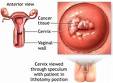Cervical Cancer - This is a photo of cervical cancer!