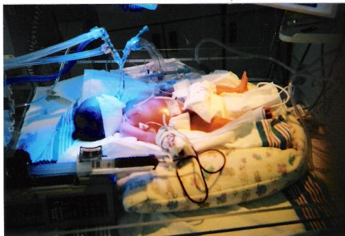 LeAnna after surgery #1 - Here's my baby girl a couple of days old. The mask covering her face is to protect her eyes from the lights being used to treat jaundice. She also has a central line (an IV in a major artery) giving her TPN & lipids (food).