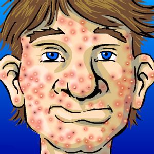 acne - pimples.