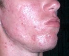 acne - Acne vulgaris is an inflammatory disease of the skin, caused by changes in the pilosebaceous units (skin structures consisting of a hair follicle and its associated sebaceous gland). Acne lesions are commonly referred to as pimples, spots or zits.

The condition is most common in puberty, especially among Western societies most likely due to a higher genetic predisposition. It is considered an abnormal response to normal levels of the male hormone testosterone. The response for most people diminishes over time and acne thus tends to disappear, or at least decrease, after one reaches their early twenties. There is, however, no way to predict how long it will take for it to disappear entirely, and some individuals will continue to suffer from acne decades later, into their thirties and forties and even beyond. Acne affects a large percentage of humans at some stage in life.--wikipedia