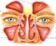 Sinusitis - Sinusitis