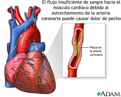 Angina Pectoris - Angina Pectoris