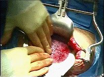 cesarean operation - a cesarean opteration under progress for birth of a new baby