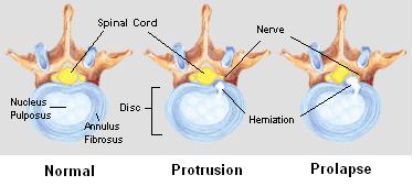 herniated disc - Some of the terms commonly used to describe the condition include herniated disc, prolapsed disc, ruptured disc, and the misleading expression 'slipped disc.' Other terms that are closely related include disc protrusion, bulging disc, pinched nerve, sciatica, disc disease, disc degeneration, degenerative disc disease, and black disc.  The popular term 'slipped disc' is quite misleading, as an intervertebral disc, being tightly sandwiched between two vertebrae, cannot actually 'slip,' 'slide,' or even get 'out of place.' The disc is actually grown together with the adjacent vertebrae and can be squeezed, stretched, and twisted, all in small degrees. It can also be torn, ripped, herniated, and degenerated, but it cannot 'slip.'  The spelling 'disc' is based on the Latin root discus. Most English language publications use the spelling 'disc' more often than 'disk.' Nomina Anatomica designates the structures as 'disci intervertebrales' [plural form] and Terminologia Anatomica as 'discus intervertebralis/Intervertebral disc,' [singular form]. [1]