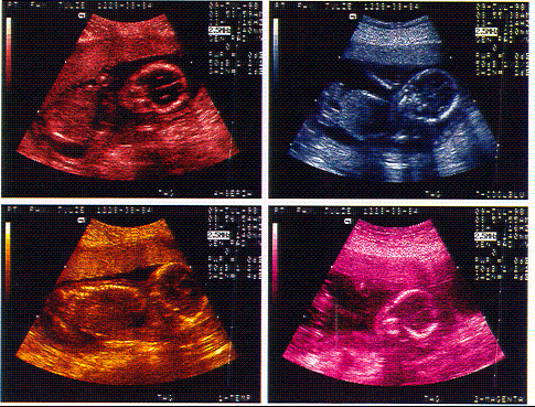 sonogram - sonogram