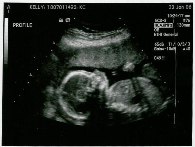sonogram - sonogram