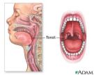 Tonsils - Tonsils