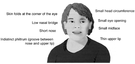 child with Fetal Alcohol Syndrome  -  This is a child's head, showing symptoms that are physical and show up quickly. FAS can happen with as little as one drink, and there's no way to tell if your child will develop it from one drink or fifty. Why risk it?