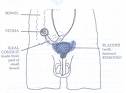 image - bladder cancer