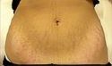 Stretchmarks - Stretchmarks