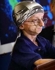 progeria - Hutchinson-Gilford Progeria syndrome is an extremely rare genetic condition which causes physical changes that resemble greatly accelerated aging in sufferers. The disease affects between 1 in 4 million (estimated actual) and 1 in 8 million (reported) newborns. Currently, there are approximately 40-45 known cases in the world. There is no known cure. Most people with progeria die around 13 years of age. Progeria is of interest to scientists because the disease may reveal clues about factors involved in the process of aging. Unlike most other'accelerated aging diseases' (such as Werner's syndrome, Cockayne's syndrome or xeroderma pigmentosum), progeria is not caused by defective DNA repair. By spreading the word I know we can help donate and contribute to the research of this disease.