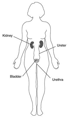 :(( - Interstitial Cystitis