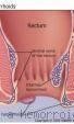 Thrombus - This is an example of thrombus in hemmorrhoids.