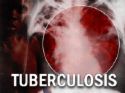 This is a picture of a lungs with PTB - Tuberculosis