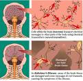 Alzheimers - What Causes Alzheimers